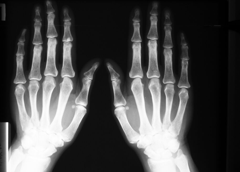 Diagnóstico por rayos X del dolor en las articulaciones de los dedos.