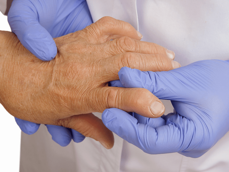 El médico revisa las articulaciones de los dedos de las manos para detectar dolor.