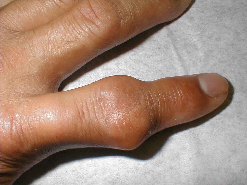 Los tofos en las articulaciones de los dedos son la causa del dolor.