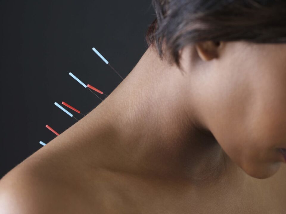La acupuntura para la osteocondrosis cervical elimina el proceso inflamatorio.